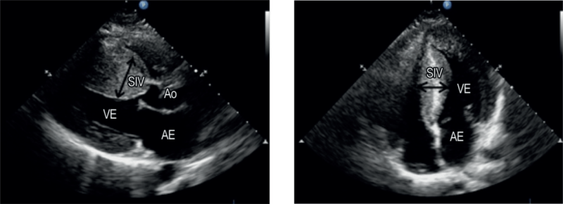 Ecocardiograma revelando hipertrofia assim&eacute;trica do septo interventricular. 