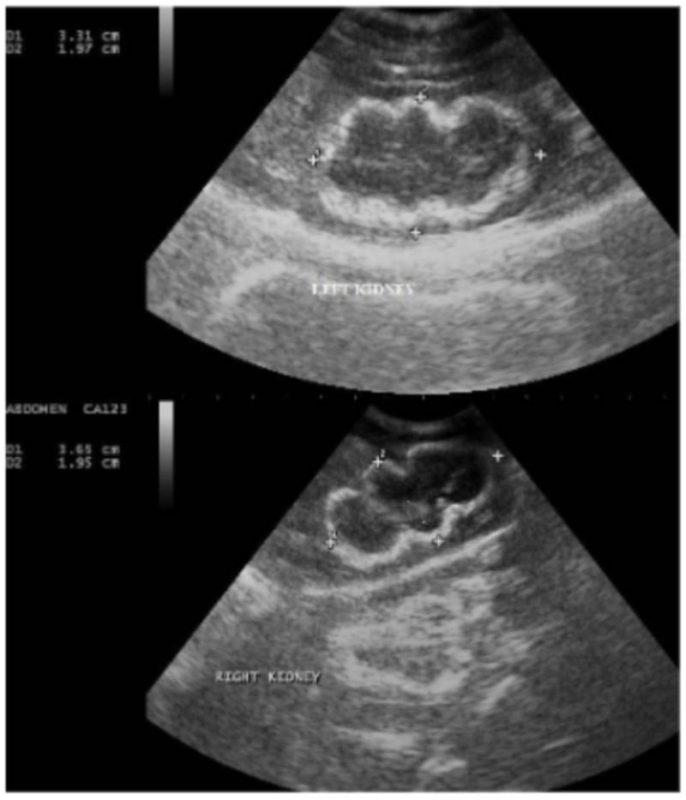 Ultrassonografia abdominal evidenciando hidronefrose bilateral em um gato