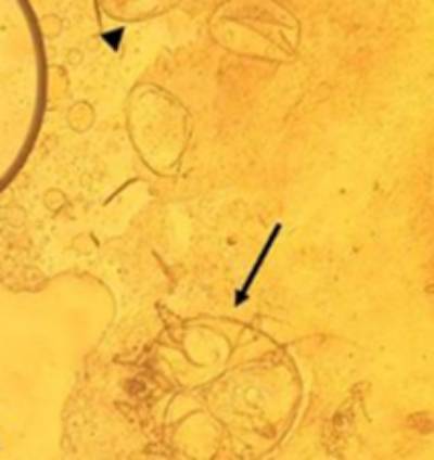 Exame parasitol&oacute;gico de pele de amostra colhida de felino que mostra um ovo de S. scabiei e a seta mostra a forma adulta de S. scabiei - causadora da sarna sarc&oacute;ptica.