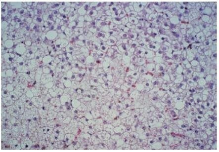 Bi&oacute;psia hep&aacute;tica de felino com lipidose hep&aacute;tica