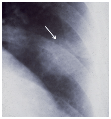 Dirofilariose pulmonar em humano. Imagem de radiografia torácica mostrando um nódulo pulmonar (seta) atribuído a D. immitis.