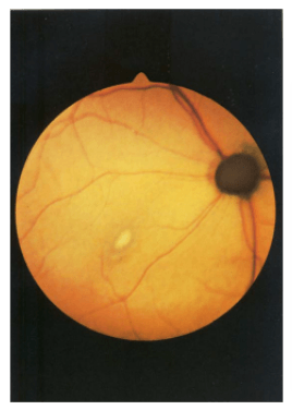 Efeito da falta de taurina na retina do animal.